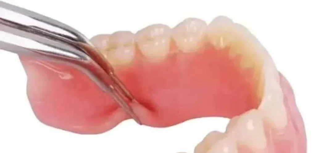 Prothèse dentaire amovible en résine souple avec base molle pour plus de confort