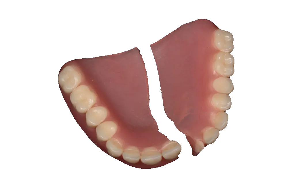 Réparation de prothèse dentaire amovible cassée en deux avant réparation