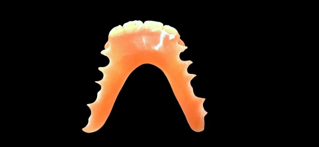 Prothèse dentaire partielle en résine sans crochet, offrant un maintien discret et un confort optimal