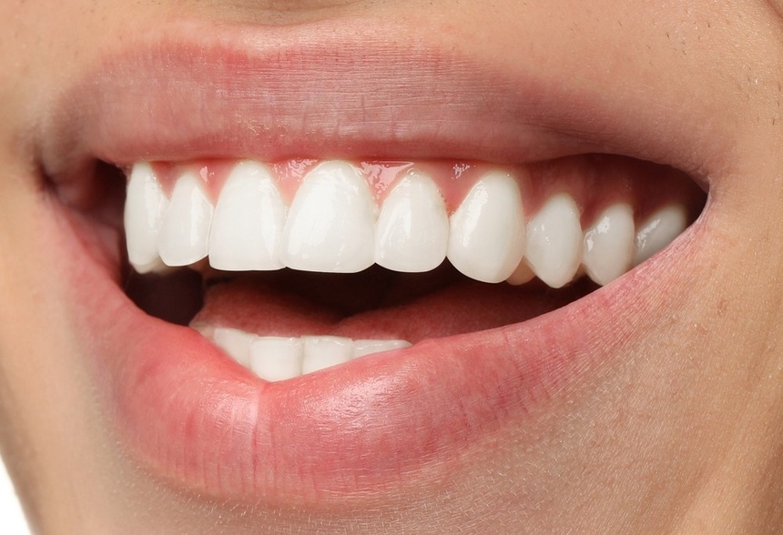 Sourire avec prothèse dentaire équipée de dents type classique