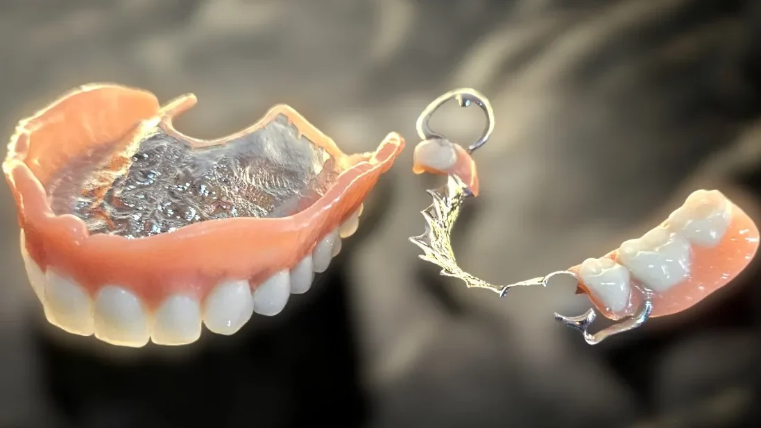Prothèse squelettique métallique (stellite) et dentier complet en résine réalisés au laboratoire Vermeulen Dental à Bruxelles