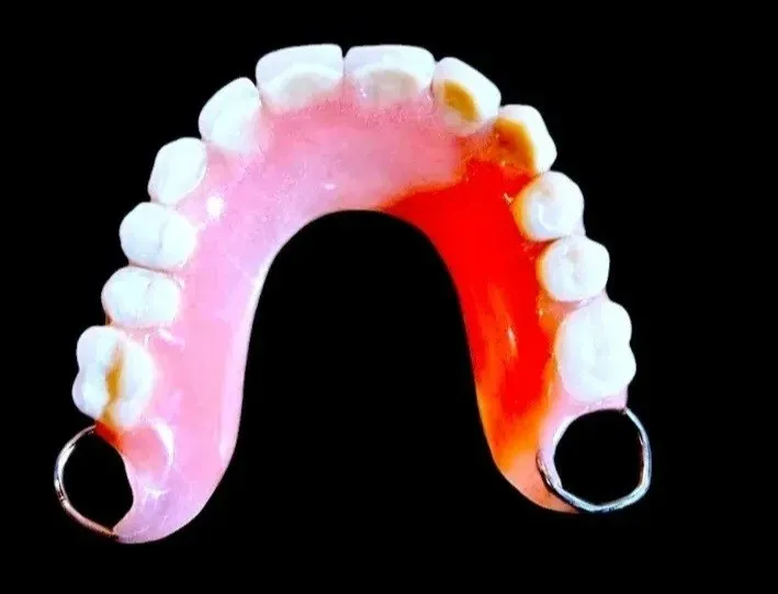 Prothèse dentaire amovible sans palais avec crochets réalisée au laboratoire à Bruxelles