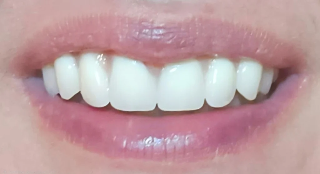 prothèse dentaire complète amovible haut et bas en résine résultat naturel Bruxelles