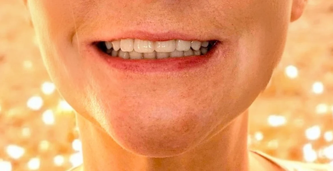 Résultat après pose d'un dentier fixe sur barre titane avec dents en résine luxe sur 6 implants supérieurs et 6 implants inférieurs à Bruxelles