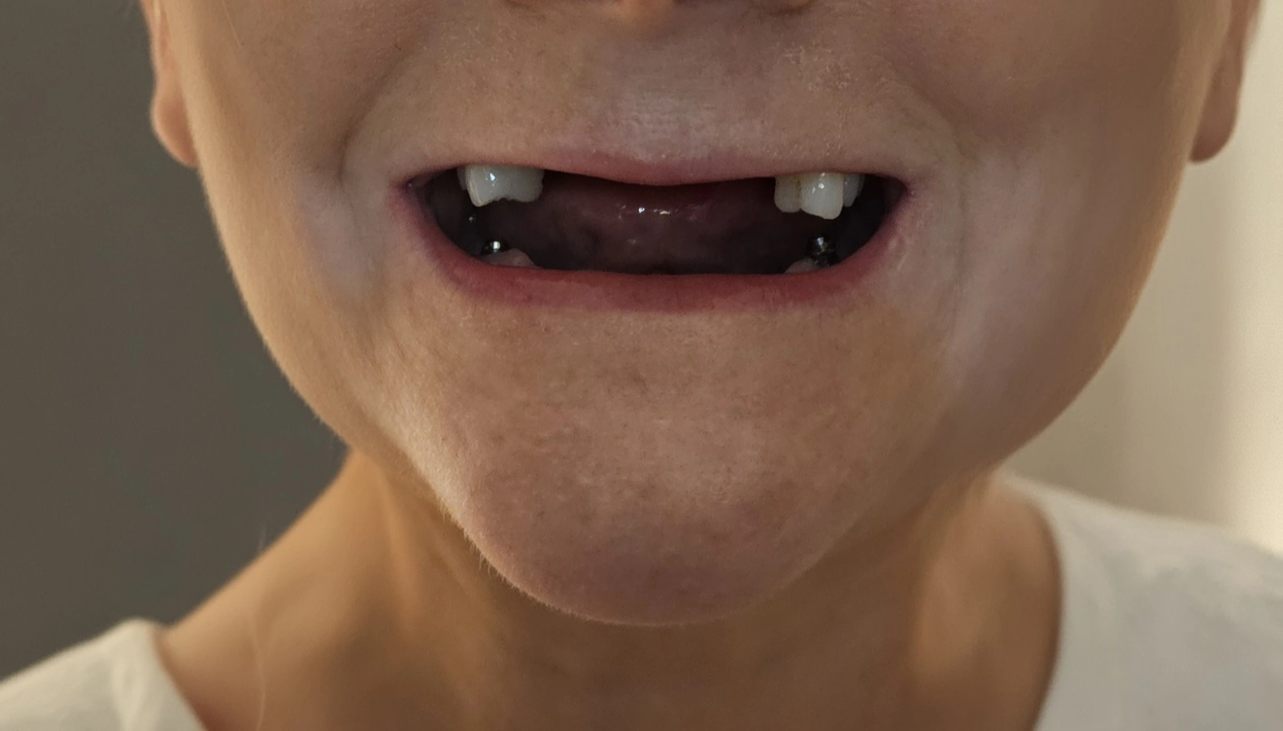 Avant pose dentier fixe sur 6 implants supérieurs et 6 implants inférieurs à Bruxelles