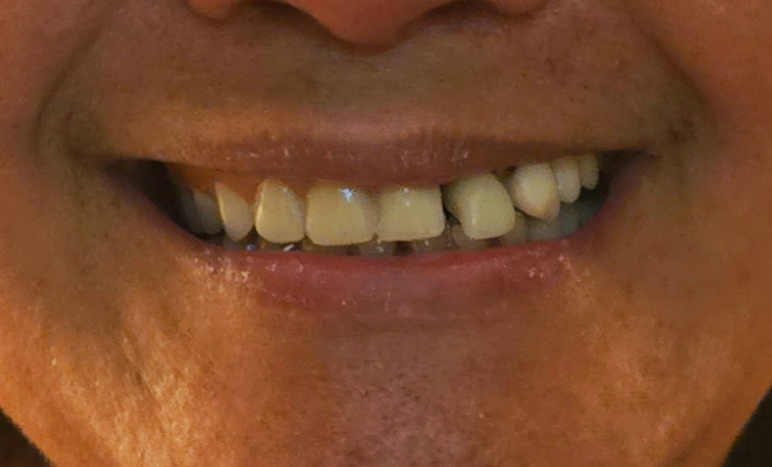 Avant remplacement d'une ancienne prothèse fixe partielle en résine avec dent cassée par mauvaise occlusion